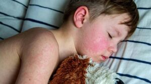 America in a panic: Deadly measles virus found in California's sewage water