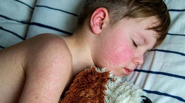 America in a panic: Deadly measles virus found in California's sewage water